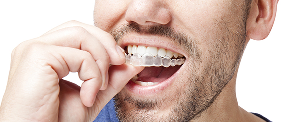 adult wearing invisalign